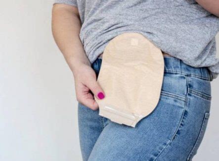 colostomy bag leaking gas|20 Failproof Tips To Prevent Your Stoma From Leaking